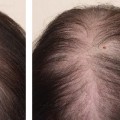 Is IPL Hair Loss Permanent? An Expert's Guide