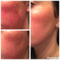 IPL Treatment: Get the Best Results Near You