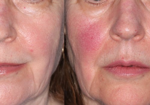 How Much Does IPL Treatment Cost for Rosacea?