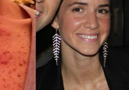 How Much Does IPL Treatment Cost? A Comprehensive Guide