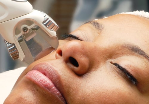 Is Skin Treatment Permanent with IPL?