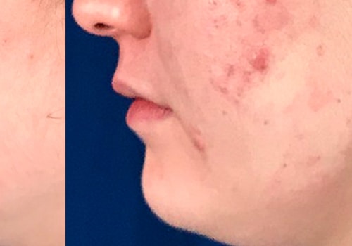 First treatment with IPL?