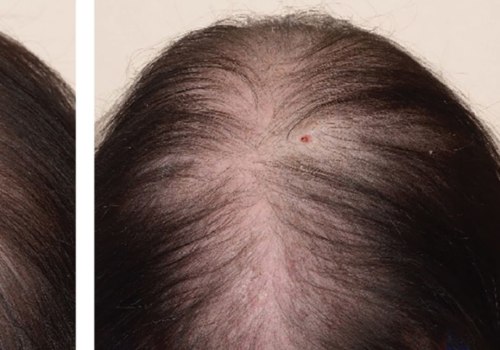 Is IPL Hair Loss Permanent? An Expert's Guide